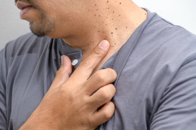 man pointing at freckles on his neck