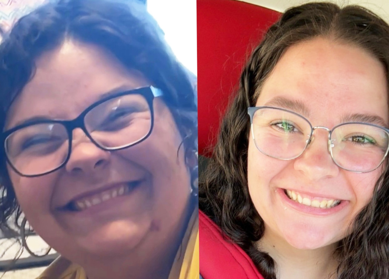 Emily smile before and after