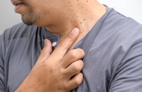 man pointing at freckles on his neck man pointing at freckles on his neck