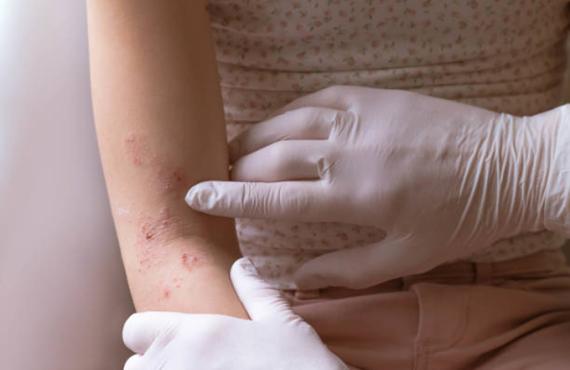 Gloved hand checking eczema on a child's arm