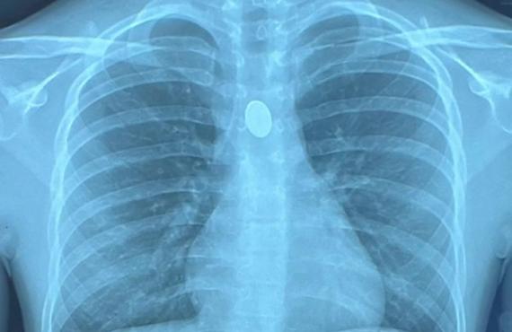 Xray of button battery lodged in esophagus