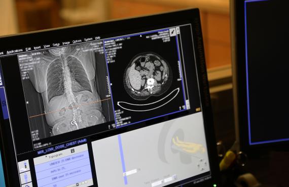 lung cancer screening images