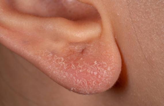 Psoriasis of the ear Psoriasis of the ear